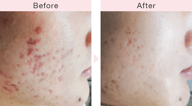 美容皮膚科横浜マリアクリニックのニキビ治療症例