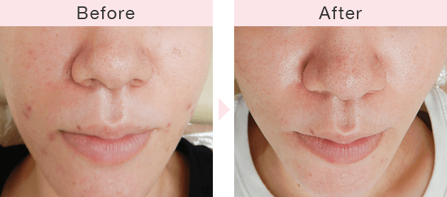 美容皮膚科横浜マリアクリニックのニキビ治療症例
