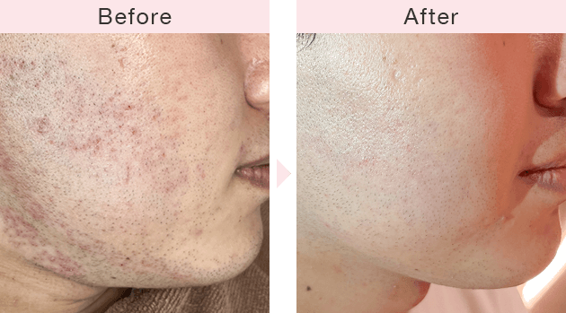 美容皮膚科横浜マリアクリニックのニキビ治療症例