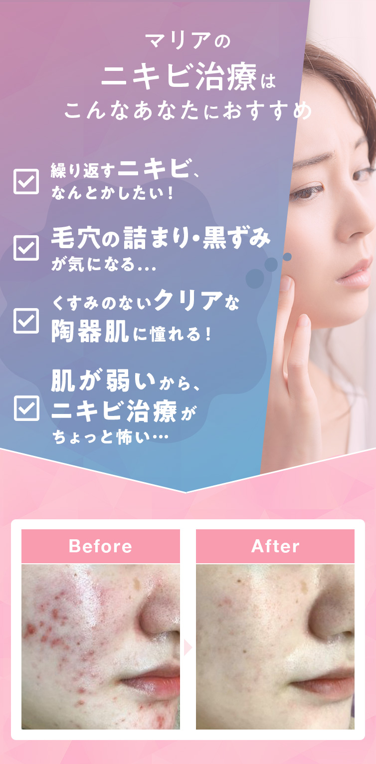 マリアのニキビ治療はこんなあなたにおすすめ