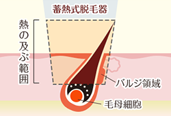 蓄熱式脱毛の仕組み