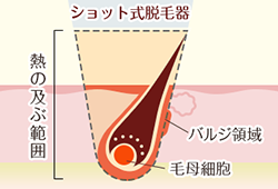 医療レーザー脱毛の仕組み