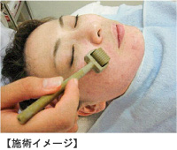 町田マリアクリニックのニューダーマローラーによるにきび治療