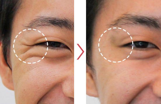 額や目尻の“シワ”を消したい！